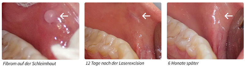 laserbehandlung bilder